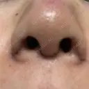 鼻尖形成（切開） / 小鼻縮小（切開） / 軟骨移植 牧野皮膚科医院 DAY 6 サムネイル用