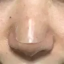 鼻尖形成（切開） / 小鼻縮小（切開） / 軟骨移植 牧野皮膚科医院 DAY 7 サムネイル用