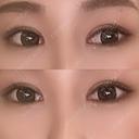 二重切開 / 目頭切開 / 眼瞼下垂（切開） / 脂肪吸引（顔） eクリニック 金沢本院 AFTER サムネイル用