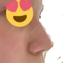 小鼻縮小（切開） Taide Suenaga Clinic（タイデスエナガクリニック） AFTER サムネイル用