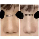 小鼻縮小（切開） Taide Suenaga Clinic（タイデスエナガクリニック） DAY 283 サムネイル用
