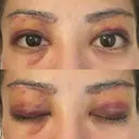 眉下切開 e:Top clinic（イートップクリニック） DAY 3 サムネイル用