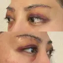 眉下切開 e:Top clinic（イートップクリニック） DAY 3 サムネイル用