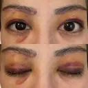 眉下切開 e:Top clinic（イートップクリニック） AFTER サムネイル用