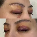 眉下切開 e:Top clinic（イートップクリニック） DAY 4 サムネイル用