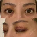 眉下切開 e:Top clinic（イートップクリニック） DAY 4 サムネイル用