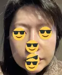 水光注射（ハリ・美肌） / 脂肪溶解注射（顔） / ヒアルロン酸注入（ほうれい線） / PRP皮膚再生療法 閉院｜プルージュ美容クリニック 赤羽院 DAY 3 サムネイル用