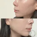 ヒアルロン酸注入（あご） 東京イセアクリニック DAY 18 サムネイル用