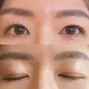 二重切開 城本クリニック 長崎院 DAY 88 サムネイル用