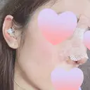 隆鼻術 / 鼻尖形成（切開） / 鼻中隔延長（切開） / 軟骨移植 / 骨切幅寄せ / 真皮移植 表参道スキンクリニック 大阪院 DAY 3 サムネイル用