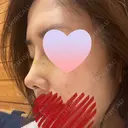 隆鼻術 / 鼻尖形成（切開） / 鼻中隔延長（切開） / 軟骨移植 / 骨切幅寄せ / 真皮移植 表参道スキンクリニック 大阪院 DAY 9 サムネイル用