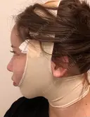 糸リフト / 脂肪吸引（顔） / ジョールファット除去 アリエル美容クリニック 大宮院 DAY 0 サムネイル用