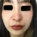 ピコレーザートーニング（美白・肝斑） B-LINE CLINIC 池袋院 DAY 8 サムネイル用