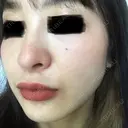 ピコレーザートーニング（美白・肝斑） B-LINE CLINIC 池袋院 DAY 8 サムネイル用