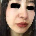 ピコレーザートーニング（美白・肝斑） B-LINE CLINIC 池袋院 DAY 8 サムネイル用