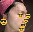 水光注射（ハリ・美肌） / 脂肪溶解注射（顔） / ヒアルロン酸注入（ほうれい線） / PRP皮膚再生療法 閉院｜プルージュ美容クリニック 赤羽院 DAY 10 サムネイル用