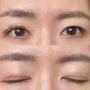 二重切開 城本クリニック 長崎院 DAY 92 サムネイル用