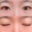 二重埋没 湘南美容クリニック 上野院 DAY 11 サムネイル用