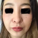 ピコレーザートーニング（美白・肝斑） B-LINE CLINIC 池袋院 DAY 9 サムネイル用