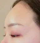 肌ヒアルロン酸注入（たるみ・シワ改善） 湘南美容クリニック 宇都宮院 DAY 10 サムネイル用