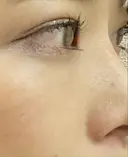 クマ治療 / 下まぶたの脂肪取り / 脂肪注入（肌） X CLINIC 大阪院 DAY 28 サムネイル用