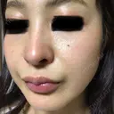 ピコレーザートーニング（美白・肝斑） B-LINE CLINIC 池袋院 DAY 10 サムネイル用