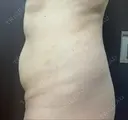脂肪溶解注射（お腹） 渋谷美容外科クリニック 新宿院 DAY 1 サムネイル用