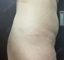 脂肪溶解注射（お腹） 渋谷美容外科クリニック 新宿院 DAY 1 サムネイル用