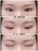 二重切開 / 上まぶたの脂肪取り 樹のひかり 形成外科・皮ふ科 DAY 22 サムネイル用