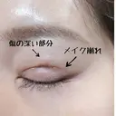 二重切開 / 上まぶたの脂肪取り 樹のひかり 形成外科・皮ふ科 DAY 22 サムネイル用