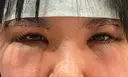 脂肪吸引（顔） / 上まぶたの脂肪取り / 下まぶたの脂肪取り / 眉下切開 LIKI CLINIC KOBE DAY 0 サムネイル用