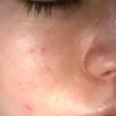 ピーリング（ニキビ・毛穴） / イオン導入 / ピーリング（ハリ・ツヤ） 渋谷美容外科クリニック 新橋院 DAY 0 サムネイル用