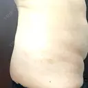 脂肪溶解注射（お腹） 渋谷美容外科クリニック 新宿院 DAY 3 サムネイル用