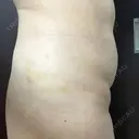 脂肪溶解注射（お腹） 渋谷美容外科クリニック 新宿院 DAY 5 サムネイル用