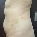 脂肪溶解注射（お腹） 渋谷美容外科クリニック 新宿院 DAY 5 サムネイル用
