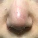 鼻尖形成（切開） / 小鼻縮小（切開） / 軟骨移植 牧野皮膚科医院 AFTER サムネイル用