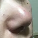 鼻尖形成（切開） / 小鼻縮小（切開） / 軟骨移植 牧野皮膚科医院 DAY 9 サムネイル用