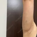 脂肪溶解注射（お腹） 渋谷美容外科クリニック 新宿院 AFTER サムネイル用