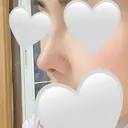 隆鼻術 / 鼻尖形成（切開） / 鼻中隔延長（切開） / 軟骨移植 / 骨切幅寄せ / 真皮移植 表参道スキンクリニック 大阪院 DAY 14 サムネイル用