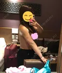 脂肪吸引（二の腕） ドクターフィット（Dr.fit）クリニック DAY 1 サムネイル用