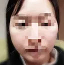 切開リフト ドクターゴールドマンクリニック 東京高輪院 AFTER サムネイル用