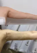 脂肪吸引（二の腕） ドクターフィット（Dr.fit）クリニック DAY 11 サムネイル用