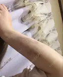 脂肪吸引（二の腕） ドクターフィット（Dr.fit）クリニック DAY 11 サムネイル用