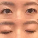 二重切開 城本クリニック 長崎院 DAY 100 サムネイル用