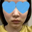 糸リフト / ボトックス（エラ・小顔） アリエル美容クリニック 大宮院 DAY 2 サムネイル用