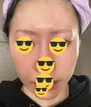 水光注射（ハリ・美肌） / 脂肪溶解注射（顔） / ヒアルロン酸注入（ほうれい線） / PRP皮膚再生療法 閉院｜プルージュ美容クリニック 赤羽院 AFTER サムネイル用
