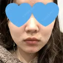 糸リフト / ボトックス（エラ・小顔） アリエル美容クリニック 大宮院 DAY 4 サムネイル用