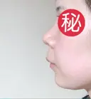 隆鼻術 / 鼻尖形成（切開） / 小鼻縮小（切開） / 軟骨移植 あいちビューティークリニック栄本院 DAY 31 サムネイル用