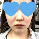 糸リフト / ボトックス（エラ・小顔） アリエル美容クリニック 大宮院 DAY 6 サムネイル用