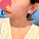 イオン導入 / フォトRF 湘南美容クリニック 表参道院 DAY 5 サムネイル用